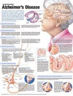 Understanding Alzheimer's Disease Anatomical Chart