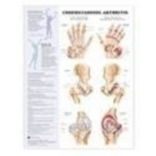 Understanding Arthritis Anatomical Chart