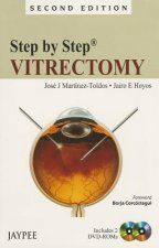 Step by Step: Vitrectomy