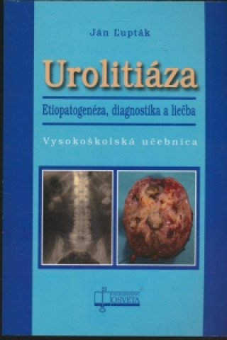Urolitiáza. Etiopatogenéza, diagnostika a liečba