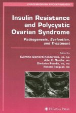 Insulin Resistance and Polycystic Ovarian Syndrome