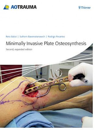 Minimally Invasive Plate Ostheosynthesis