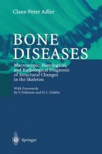 Bone Diseases