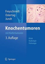 Knochentumoren mit Kiefertumoren