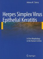 Herpes Simplex Virus Epithelial Keratitis