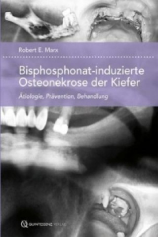 Bisphosphonat-induzierte Osteonekrose der Kiefer