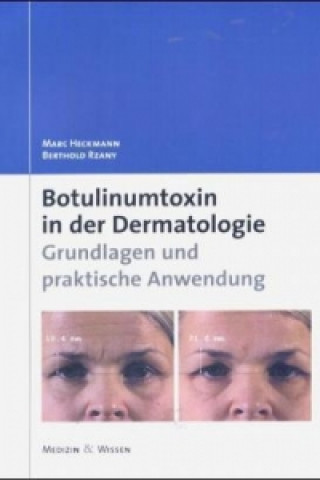 Botulinumtoxin in der Dermatologie