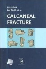 Calcaneal Fracture