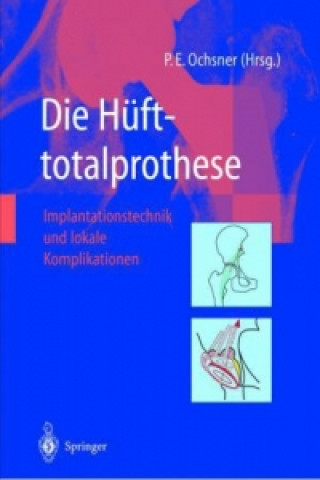 Die Hufttotalprothese