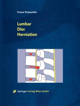 Lumbar Disc Herniation