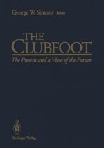 Clubfoot