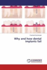 Why and how dental implants fail