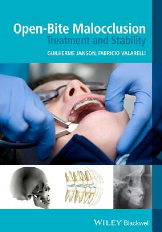 Open-Bite Malocclusion - Treatment and Stability