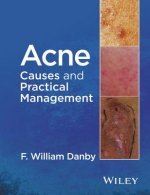 Acne - Causes and Practical Management