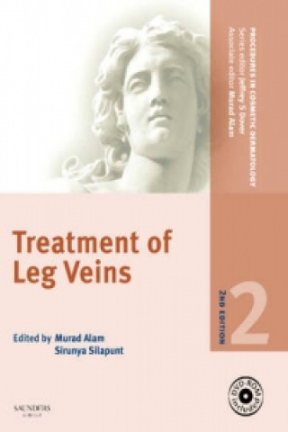 Treatment of Leg Veins