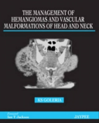 Management of Haemangiomas and Vascular Malformations of Head and Neck
