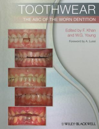 Toothwear - The ABC of the Worn Dentition