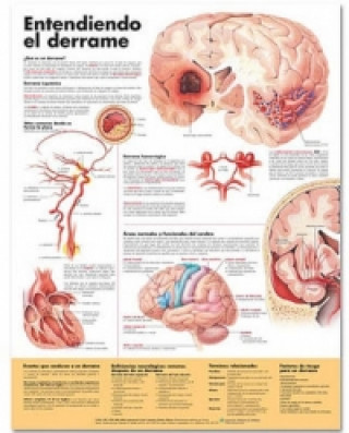 Understanding Stroke Anatomical Chart in Spanish (Entendiendo que es un derrame)
