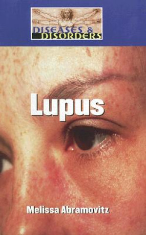 Lupus