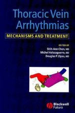 Thoracic Vein Arrhythmias - Mechanisms and Treatment