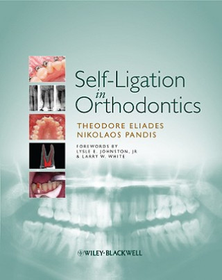 Self-Ligation in Orthodontics