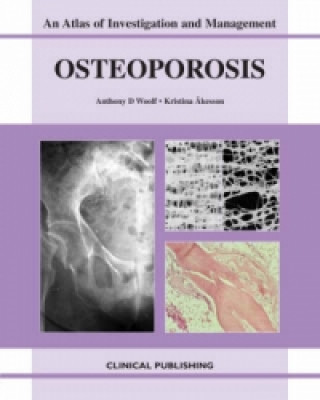 Osteoporosis