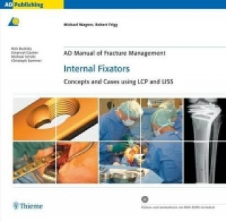 AO Manual of Fracture Management - Internal Fixators