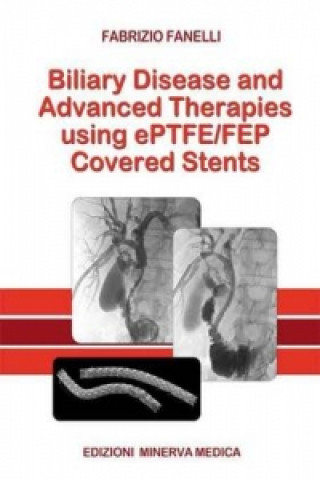 Biliary Disease and Advanced Therapies Using ePTFE/FEP Covered Stents
