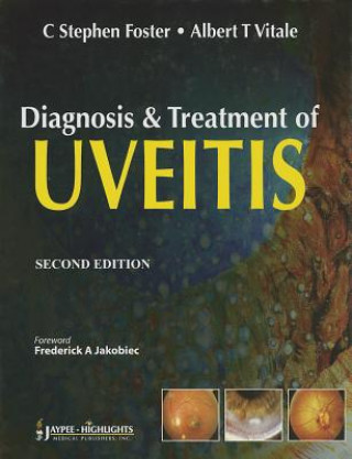 Diagnosis & Treatment of Uveitis