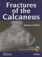 Fractures of the Calcaneus