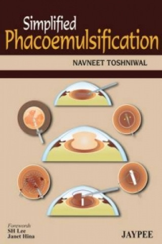 Simplified Phacoemulsification