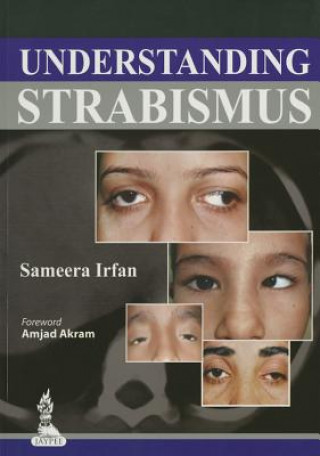 Understanding Strabismus