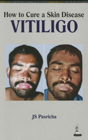 How to Cure a Skin Disease: Vitiligo