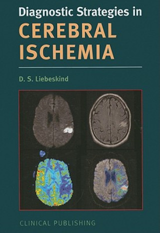 Cerebral Ischemia