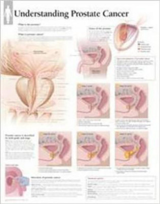 Understanding Prostate Cancer Laminated Poster