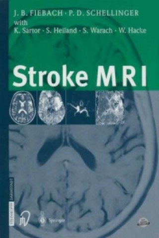 Stroke MRI, 1