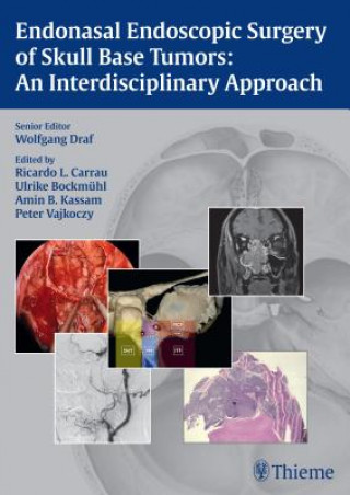 Endonasal Endoscopic Surgery of Skull Base Tumors: An Interdisciplinary Approach (Wolfgang Draf,Wolfgang Draf,Ricardo L. Carrau,Ulrike Bockmühl,Amin B