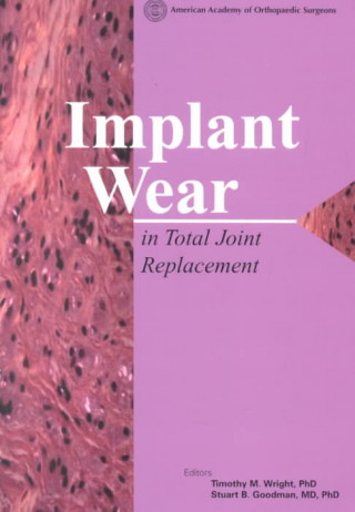 Implant Wear in Total Joint Replacement