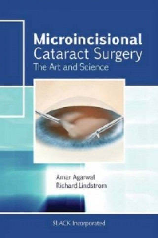 Microincisional Cataract Surgery