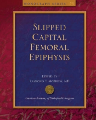 Slipped Capital Femoral Epiphysis