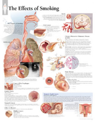 Effects of Smoking Laminated Poster