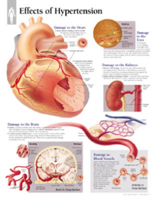 Effects of Hypertension Paper Poster