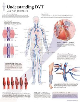 Understanding DVT Laminated Poster