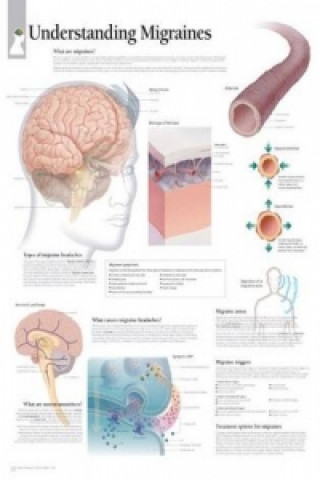 Understanding Migraines Paper Poster