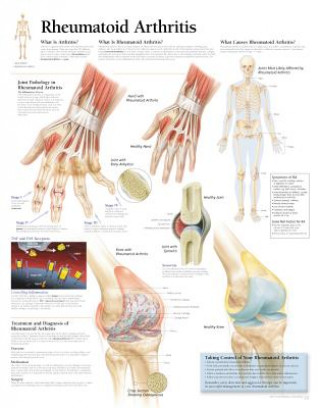 Rheumatoid Arthritis Laminated Poster