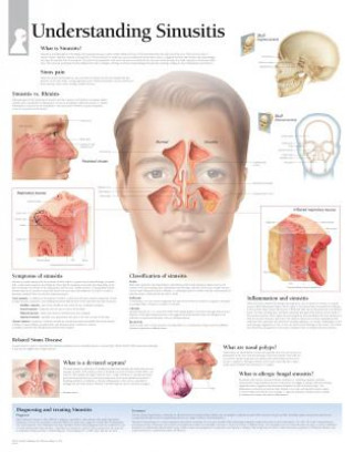 Understanding Sinusitis Laminated Poster