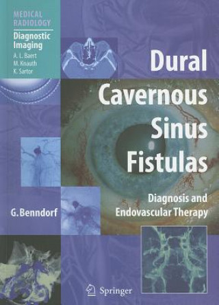 Dural Cavernous Sinus Fistulas