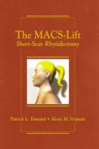 Macs-Lift Short Scar Rhytidectomy