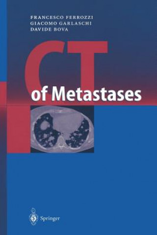 CT of Metastases