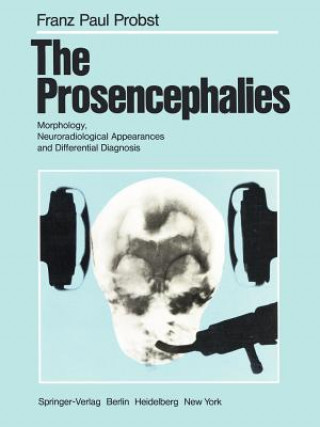 Prosencephalies